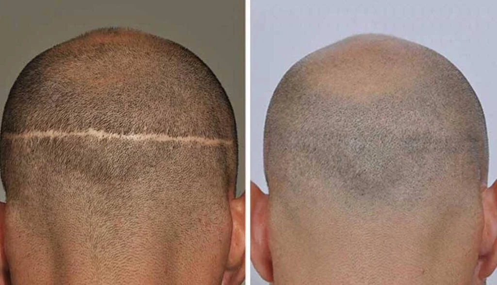 FUT Hair Transplant In Pakistan
